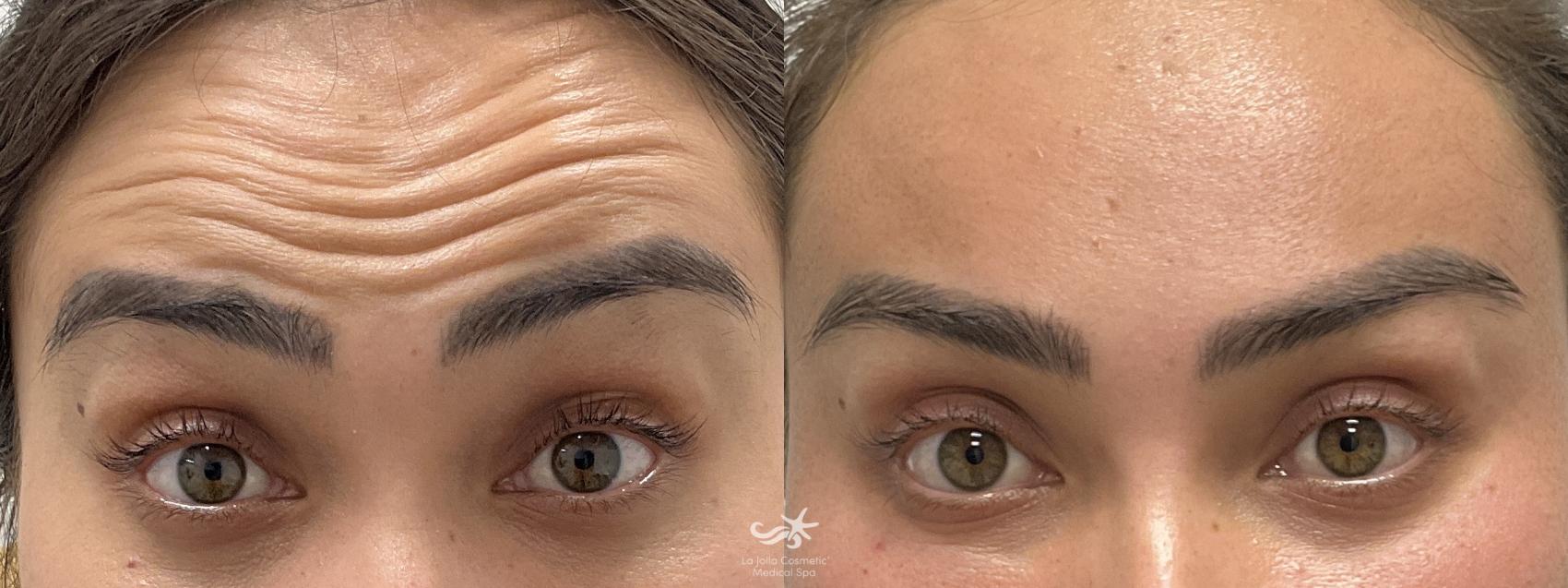 Before & After BOTOX® Cosmetic Result 825 Front View in San Diego, Carlsbad, CA