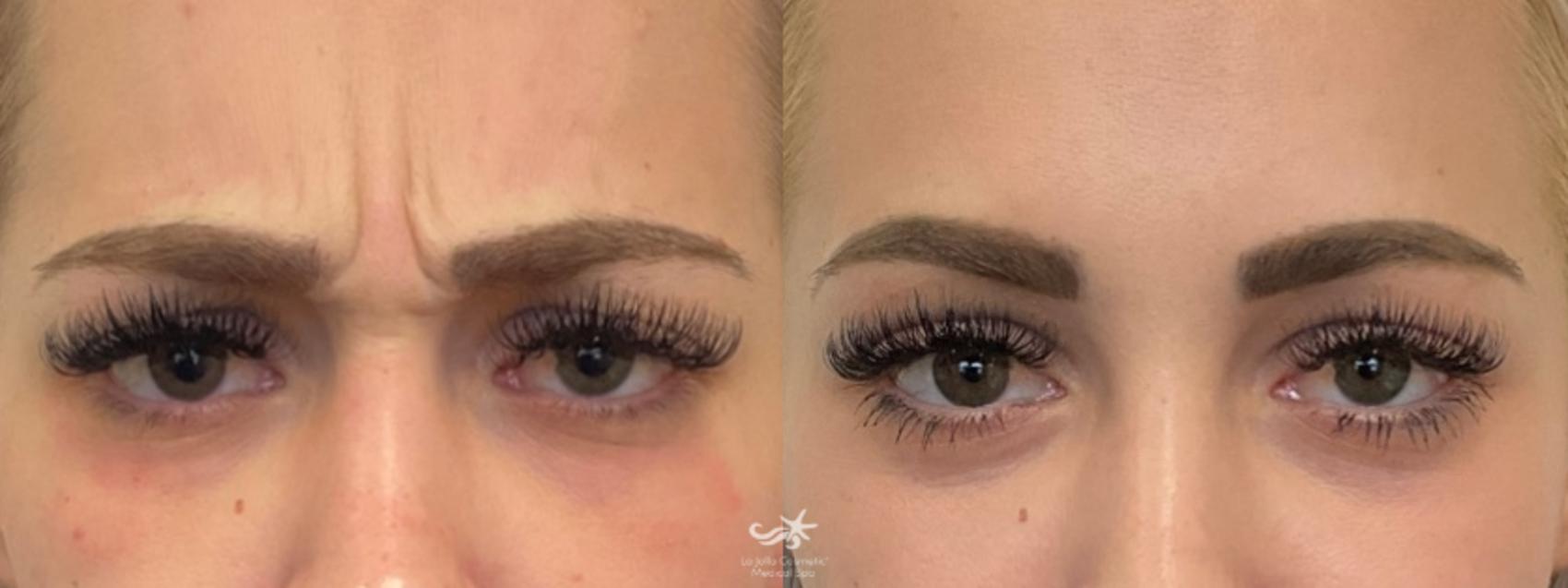 Before & After BOTOX® Cosmetic Result 868 Front View in San Diego, Carlsbad, CA