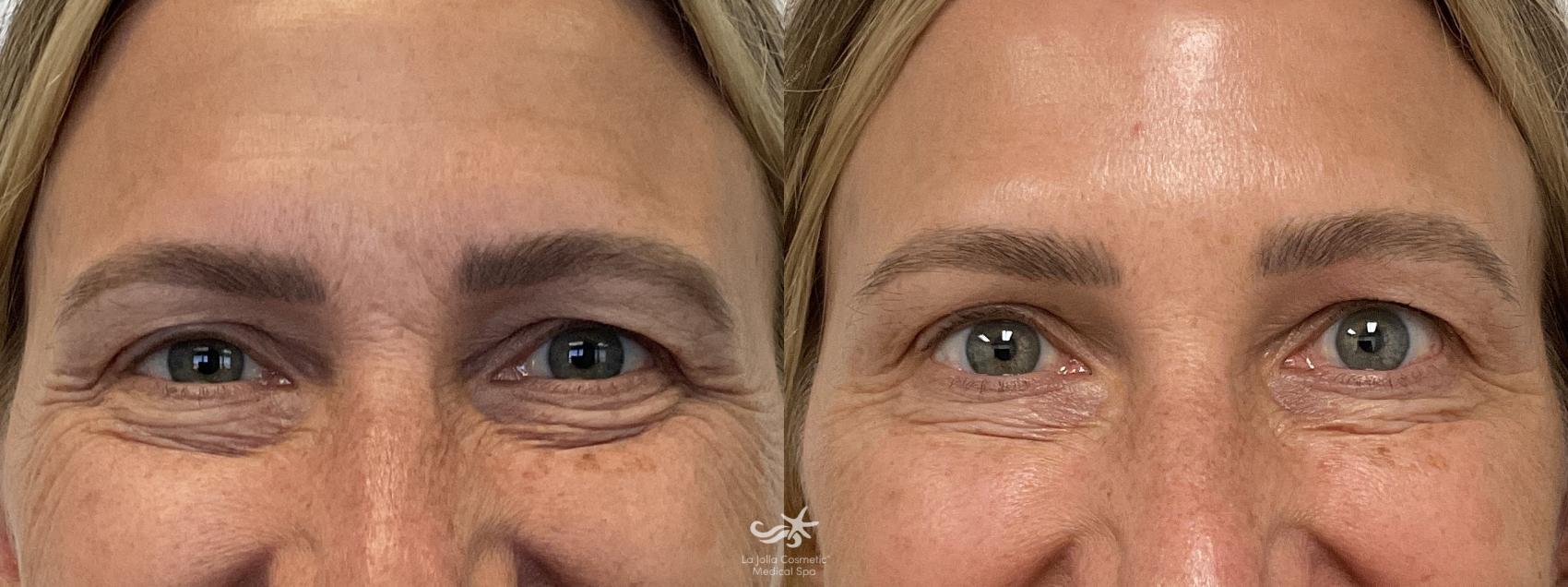 Before & After BOTOX® Cosmetic Result 909 Front View in San Diego, Carlsbad, CA