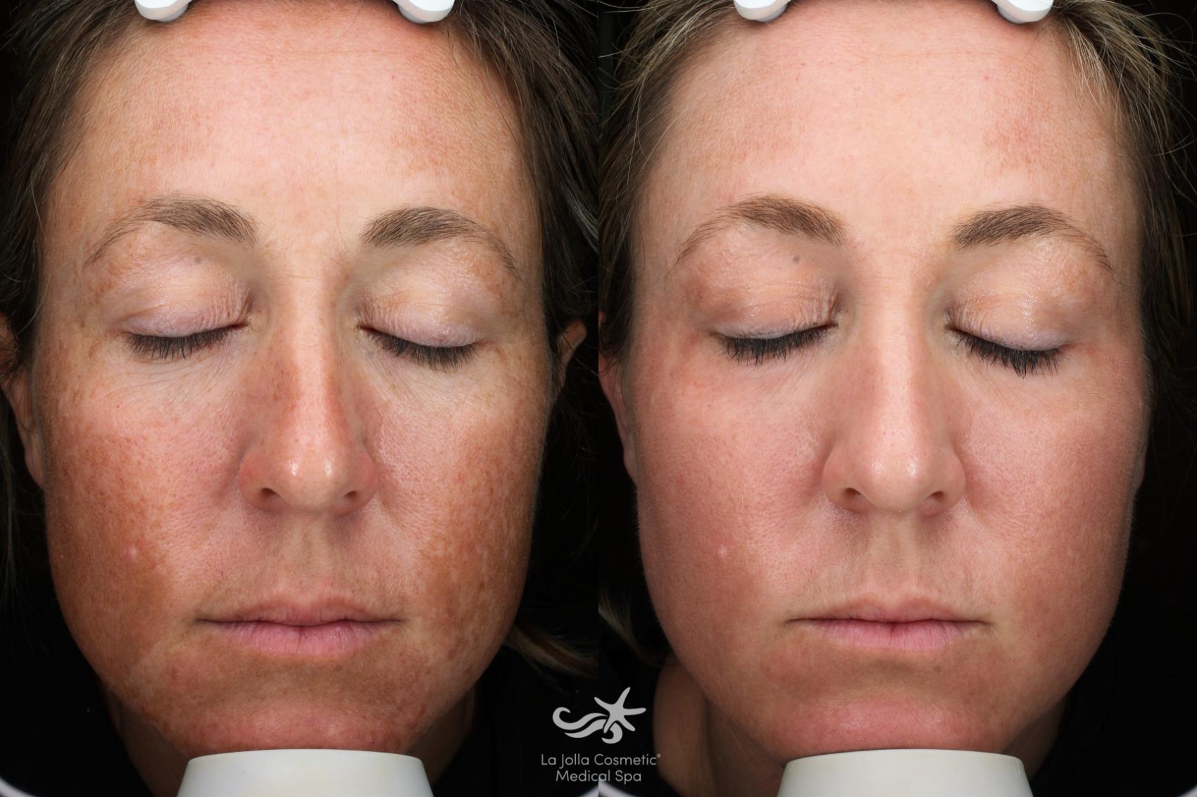 Before & After HALO™ Laser Treatment Result 129 Front View in San Diego, Carlsbad, CA