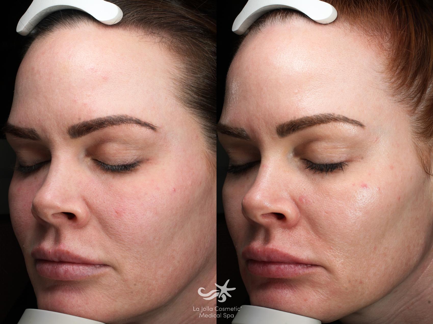 Before & After HALO™ Laser Treatment Result 830 Front View in San Diego, Carlsbad, CA