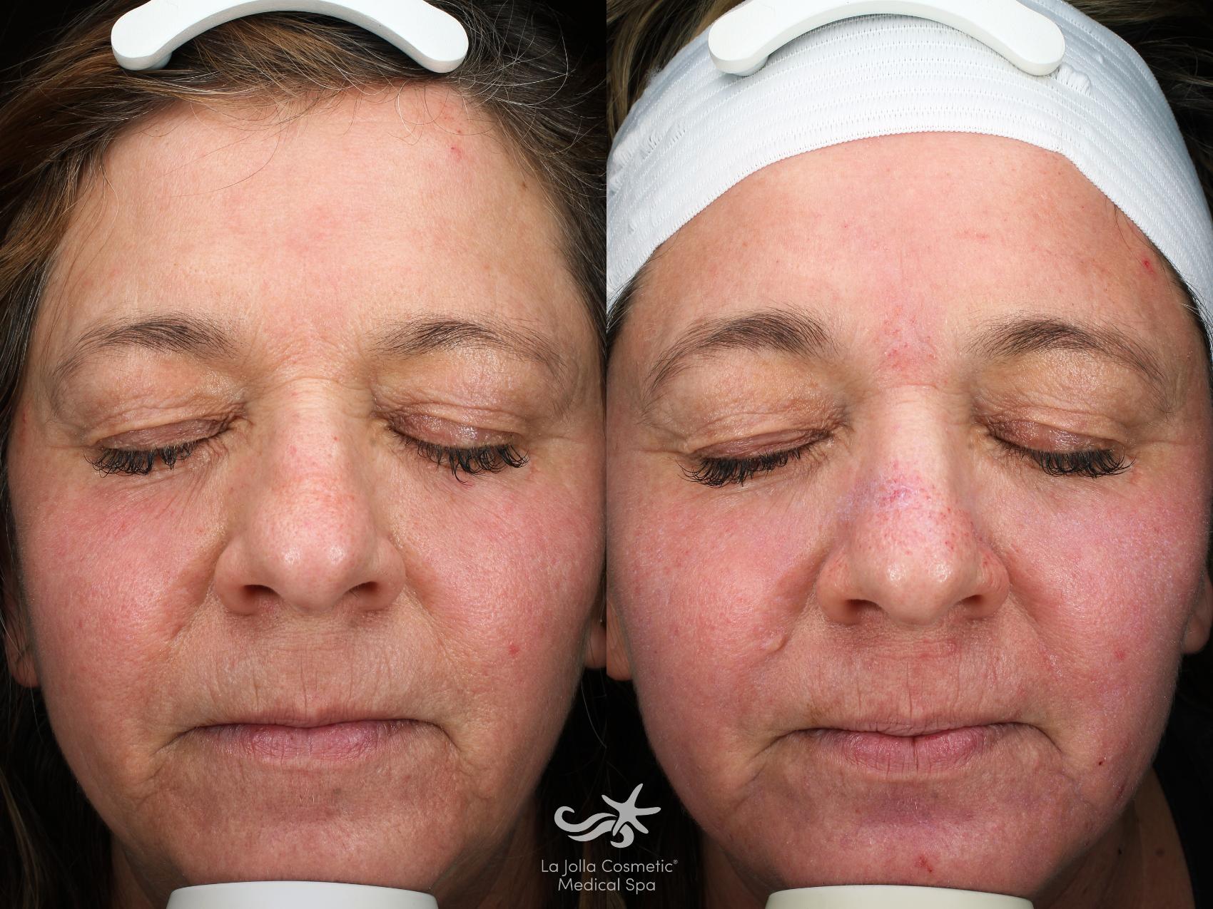 Before & After HALO™ Laser Treatment Result 832 Front View in San Diego, Carlsbad, CA
