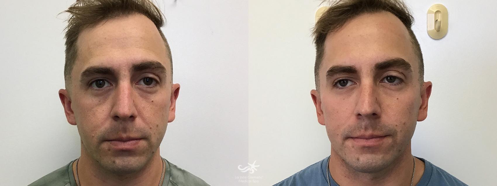 Before & After Juvéderm® Vollure™ Result 547 Front View in San Diego, Carlsbad, CA