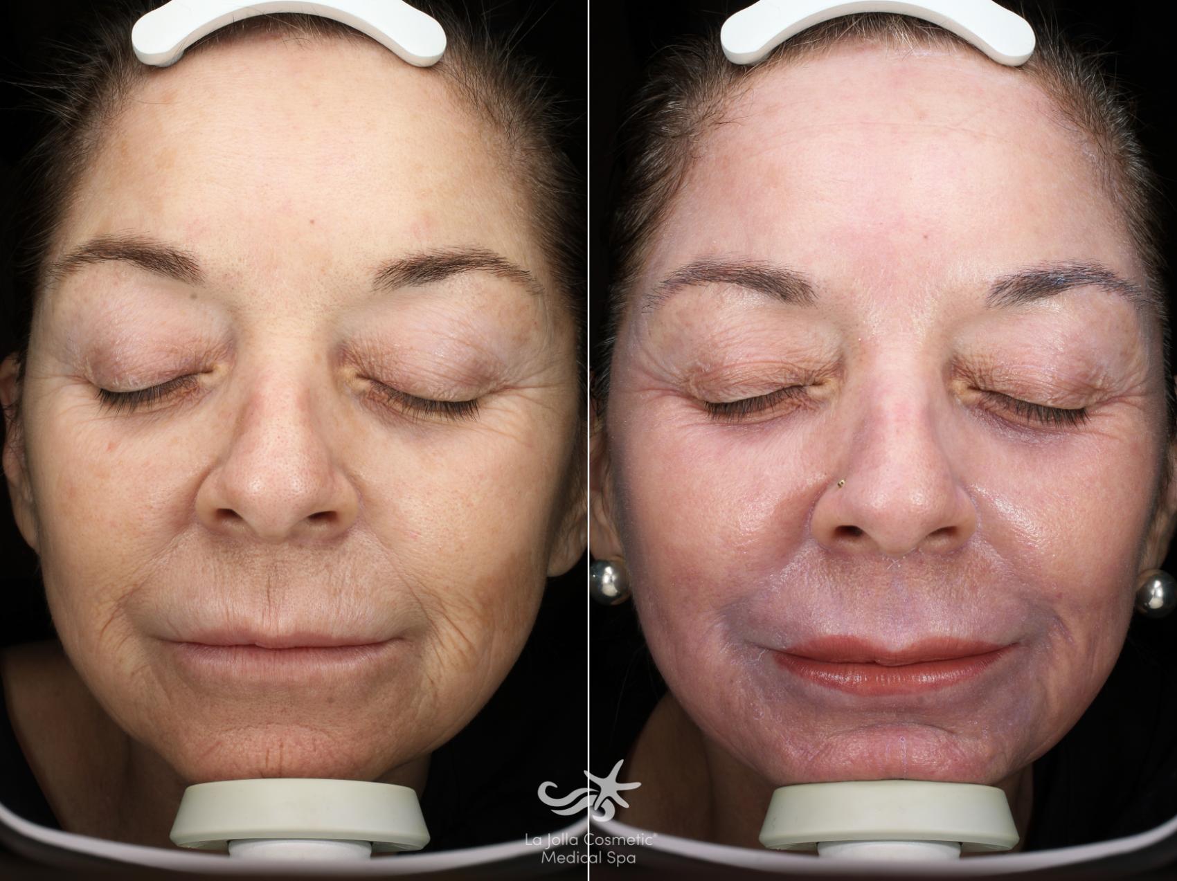 Before & After Profractional™ Laser Skin Resurfacing Result 543 Front View in San Diego, Carlsbad, CA