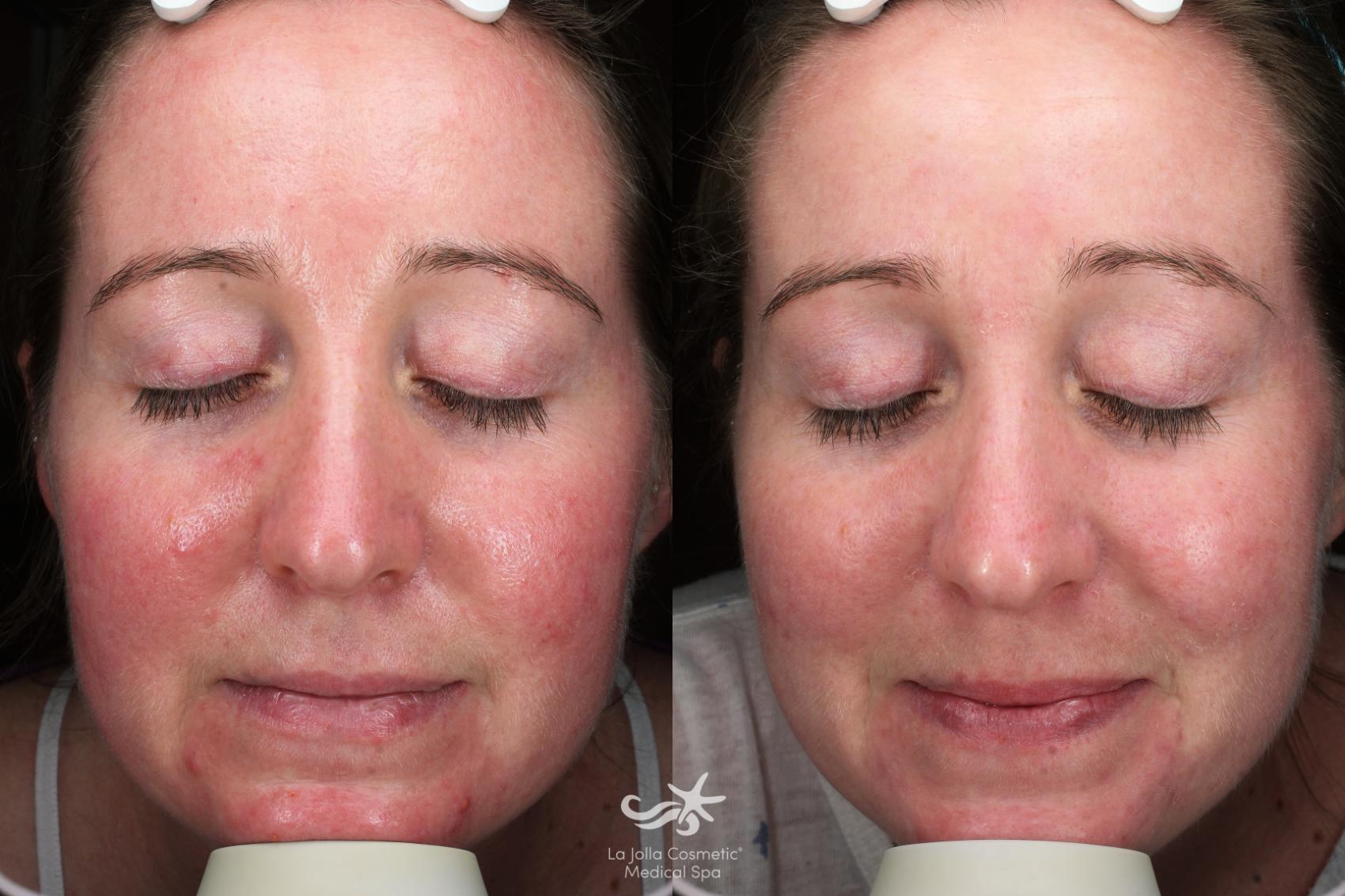 Before & After VBeam Laser Result 640 Front View in San Diego, Carlsbad, CA
